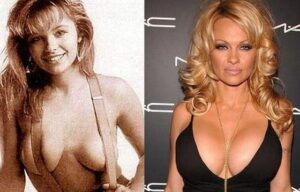 Before and after picture of Pamela Anderson