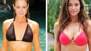 Denise Richards before and after her surgery