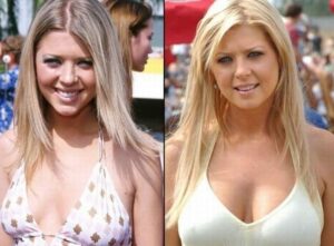 Tara Reid before and after her surgery