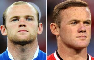 Before and after hair transplant photo of Wayne Rooney
