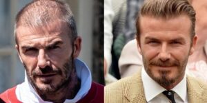 David Beckham before and after hair transplant