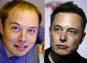 Elon Musk's photo before and after hair transplant