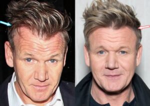 Gordon Ramsay before and after hair transplant