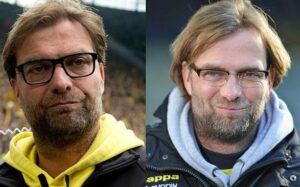 Jurgen Klopp before and after hair transplant